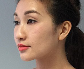 Facial Reshaping Medical Spa Treatment After