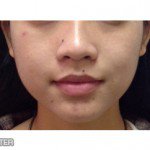 Botox Before & After Patient #9246