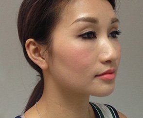 Kim Facial Reshaping After
