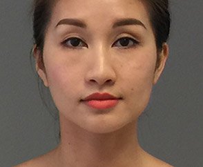 Facial Reshaping Med Spa After