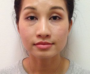 Facial Reshaping Medical Spa Treatment Before