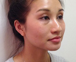 Kim Facial Reshaping Before