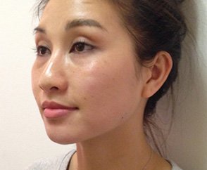 Facial Reshaping Treatment Before