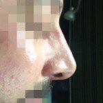 Juvederm Before & After Patient #9305