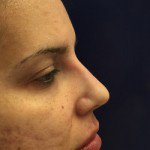 Nose Reshaping Before & After Patient #9704