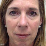 Botox Before & After Patient #9267