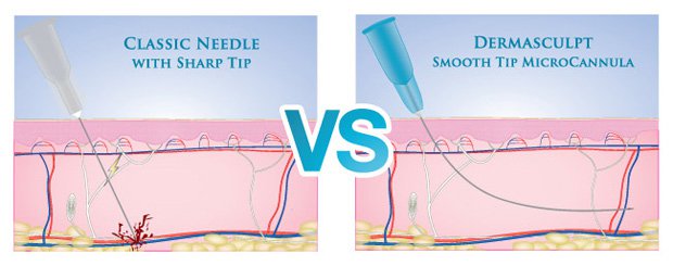 needle_vs_cannula