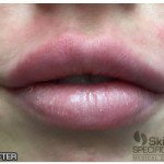 Lip Fillers Before & After Patient #10113