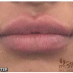 Lip Fillers Before & After Patient #10116