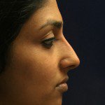 Nose Reshaping Before & After Patient #10333