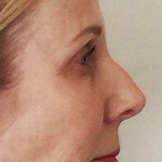 Nose Reshaping Before & After Patient #10401