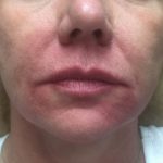 Juvederm Before & After Patient #10682